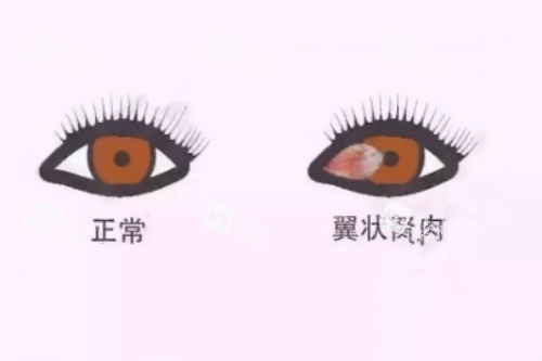 翼狀胬肉與正常眼睛對比 翼狀胬肉與正常眼睛對比