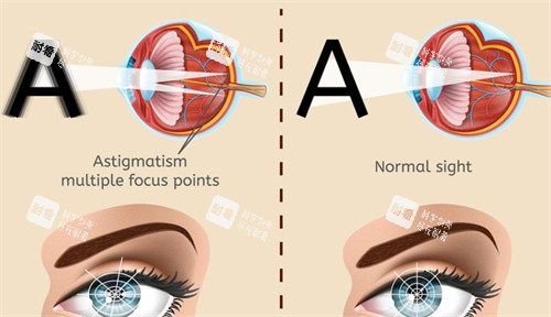 眼球震顫與正常眼睛視物的區(qū)別 眼球震顫與正常眼睛視物的區(qū)別