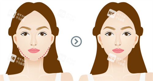 面部提升前后對(duì)比