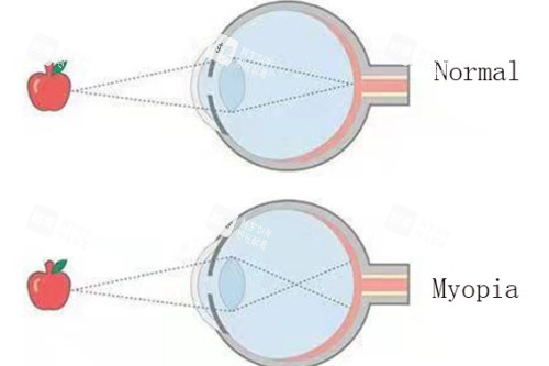 近視眼與正常眼對比