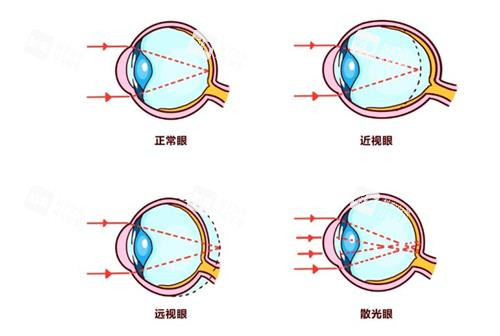 遠(yuǎn)視眼和近視眼的區(qū)別