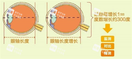 眼軸長度與近視