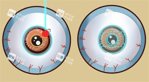 激光類近視手術(shù)和ICL晶體植入手術(shù)