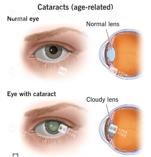 正常眼睛和白內(nèi)障眼睛 正常眼睛和白內(nèi)障眼睛