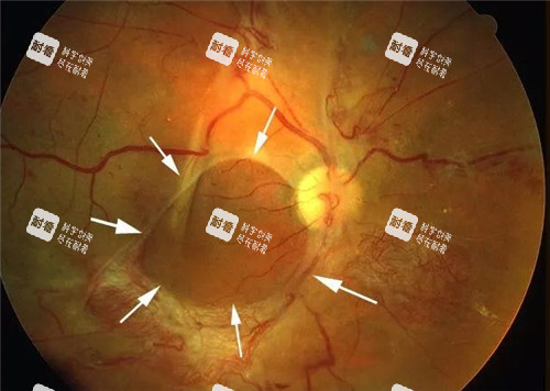 視網(wǎng)膜脫落細(xì)節(jié)表現(xiàn)圖