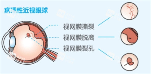 視網(wǎng)膜問題