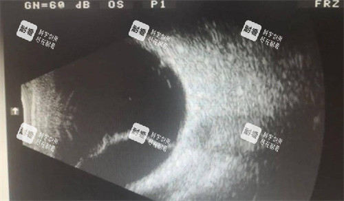 視網(wǎng)膜脫落的眼底