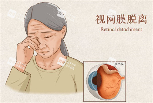 視網(wǎng)膜脫落的癥狀