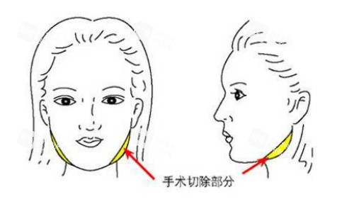 面部磨骨手術示意圖 面部磨骨手術示意圖