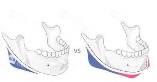 磨骨前后對比示意圖 磨骨前后對比示意圖