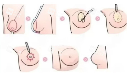 雙環(huán)法縮胸展示