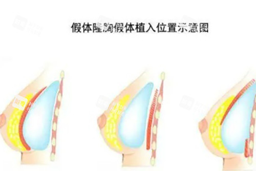 假體隆胸示意圖