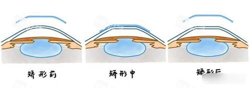晶體植入矯正近視前中后漫畫示意圖