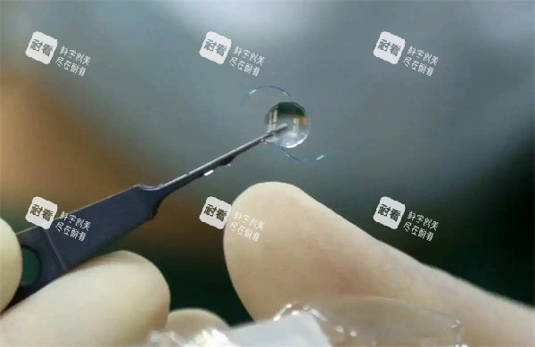 晶體植入特寫(xiě)照片