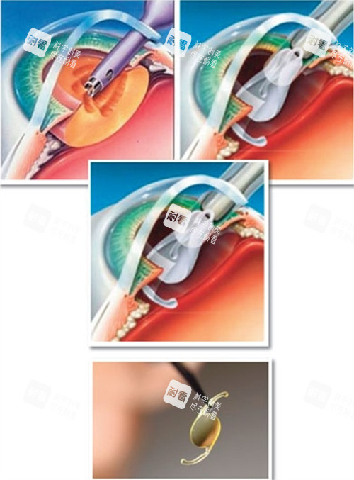 手術(shù)中放置人工晶體