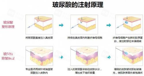 玻尿酸注射原理
