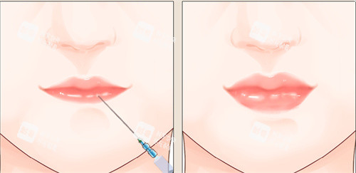注射豐唇手術(shù)