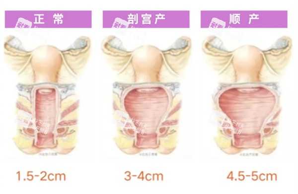 正常陰道和松弛對比照片