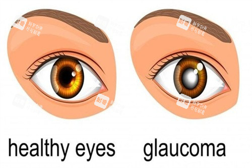 青光眼對(duì)比 青光眼對(duì)比