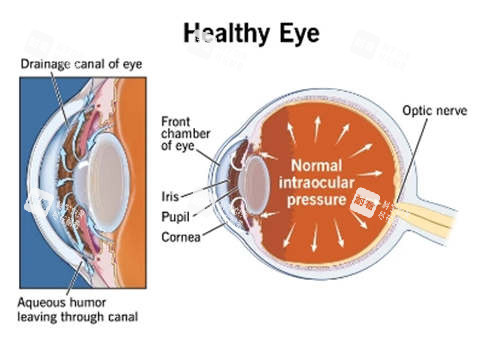 青光眼2 青光眼2