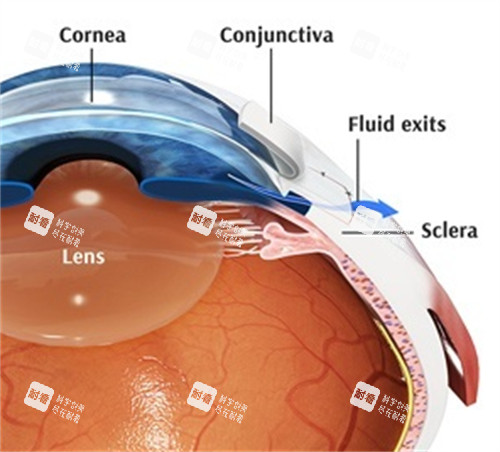 青光眼內(nèi)部問(wèn)題 青光眼內(nèi)部問(wèn)題