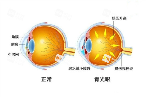 青光眼與正常眼對(duì)比 青光眼與正常眼對(duì)比