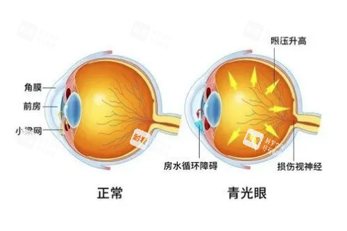 正常眼睛與青光眼概念對(duì)比 正常眼睛與青光眼概念對(duì)比