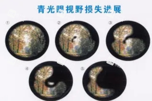 青光眼視野損失進(jìn)展展示圖 青光眼視野損失進(jìn)展展示圖