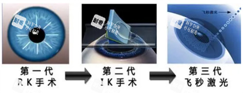 近視手術(shù)的進(jìn)階過程