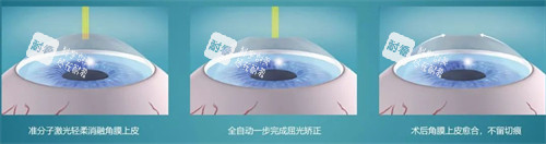 近視手術簡要流程