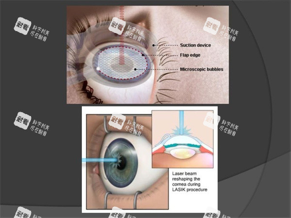 近視眼手術照片