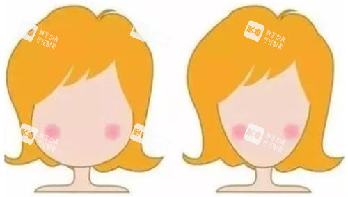 打針瘦臉明顯對比圖