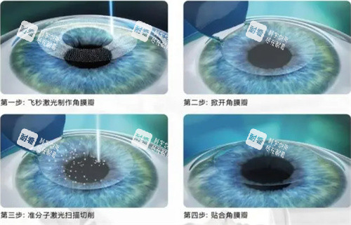 半飛秒手術圖 半飛秒手術圖
