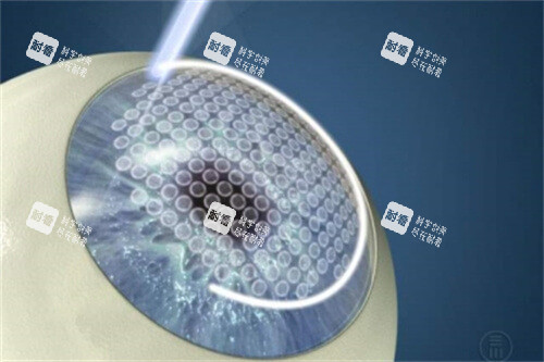 半飛秒激光手術(shù)過程 半飛秒激光手術(shù)過程