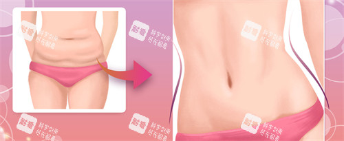 腹壁成形手術(shù)對(duì)比圖