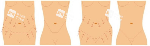 腹壁成形可改善的腰腹?fàn)顟B(tài)