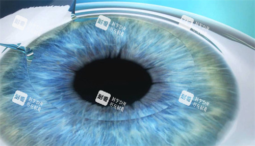 近視手術(shù)前眼睛制瓣 近視手術(shù)前眼睛制瓣