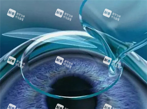 激光近視眼手術(shù)細(xì)節(jié)圖