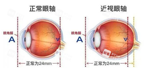 近視眼軸長度圖片