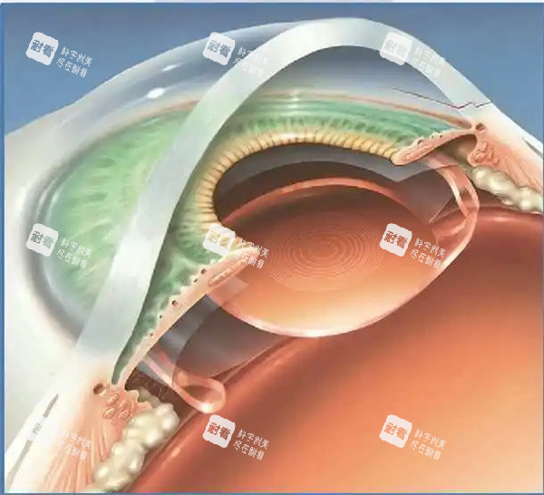 近視眼眼睛圖片