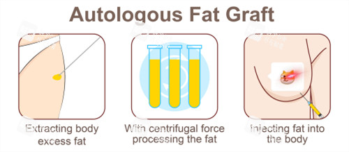 自體脂肪隆胸