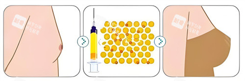 自體脂肪隆胸對比
