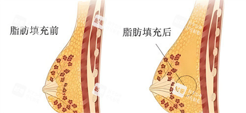 自體脂肪隆胸脂肪對比