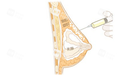自體脂肪隆胸通圖