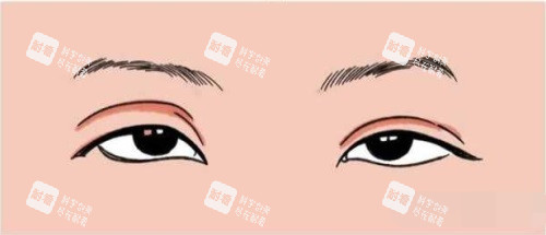 雙眼皮過(guò)寬