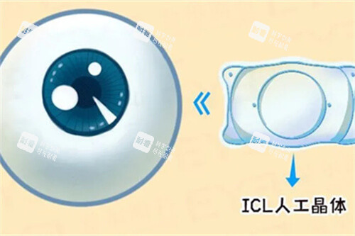 icl人工晶體與眼球漫畫圖 icl人工晶體與眼球漫畫圖