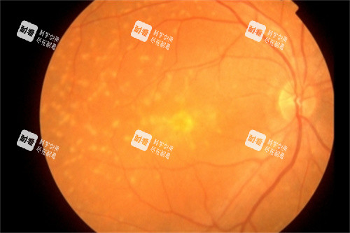 眼底黃斑示意圖