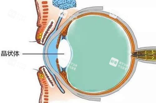 白內(nèi)障位置展示 白內(nèi)障位置展示