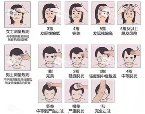 發(fā)際線測(cè)量規(guī)范