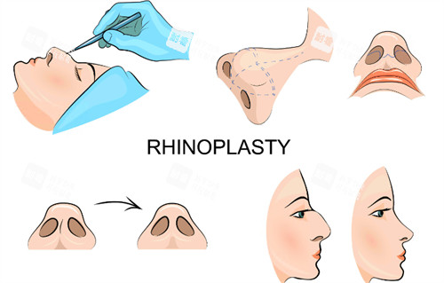 隆鼻過(guò)程圖示